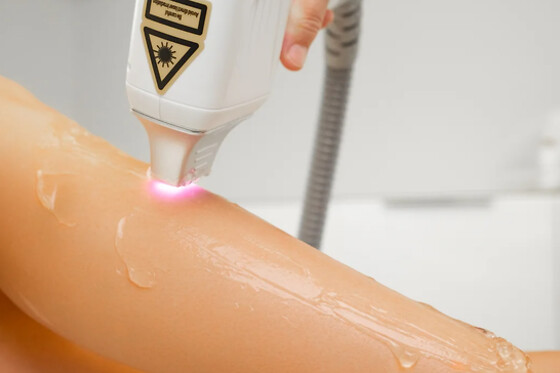 Sessão de HIFU corpo para 1 | Lucare Estética & Bem Estar (Amadora)